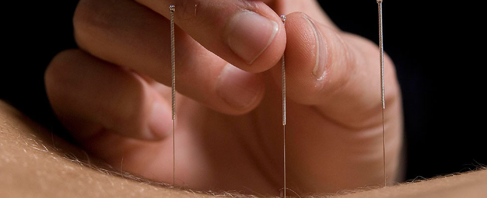 Acupuncture